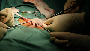 最新植髮技術：解決脫髮問題嘅有效方法